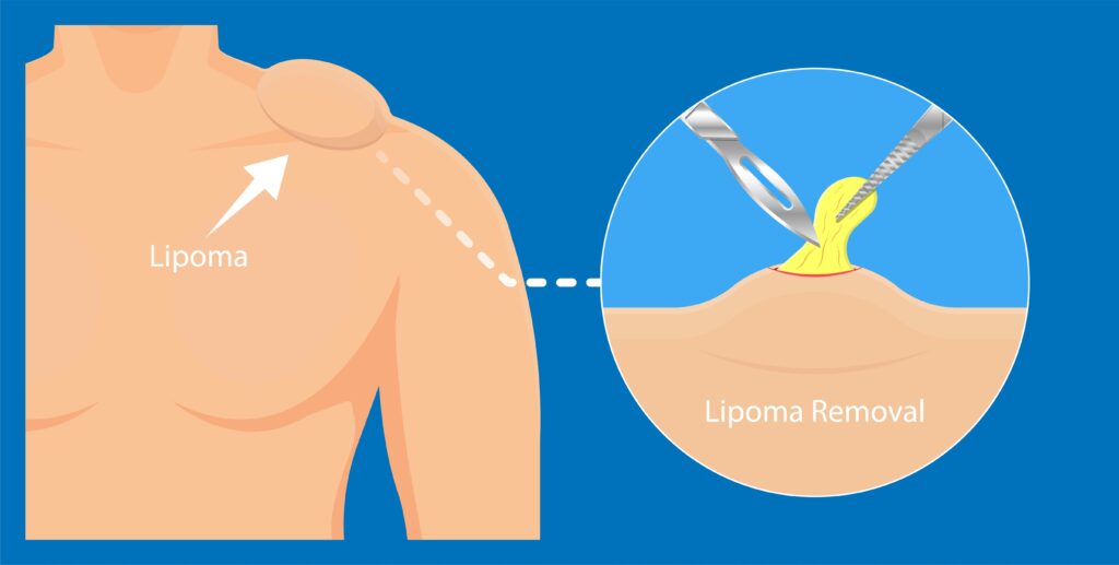 Lipoma Removal