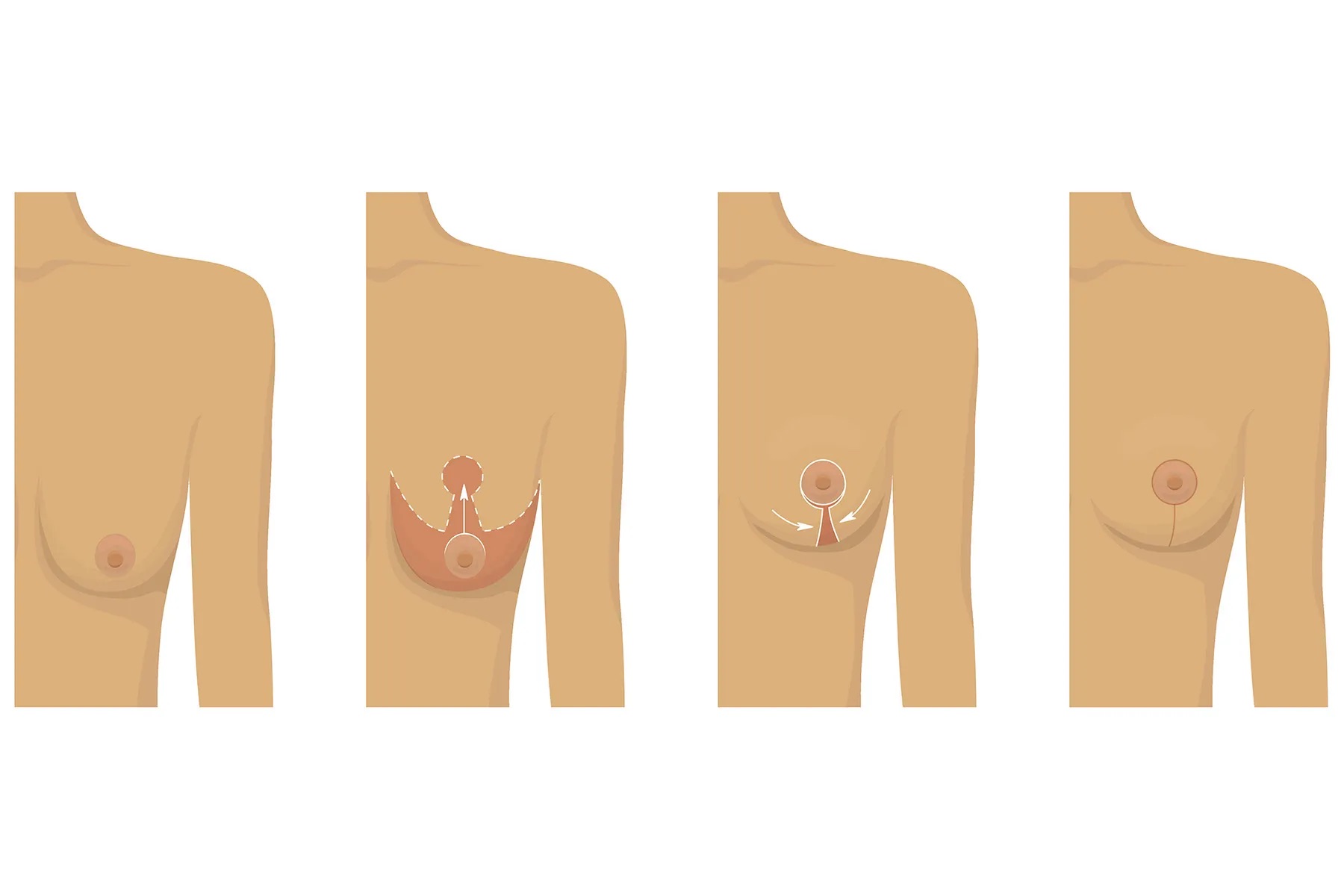 Breast Reduction Procedure